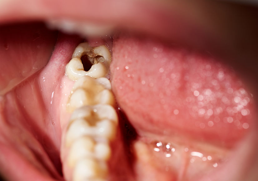 Top 5 Most Deceivingly Bad Foods For Your Teeth