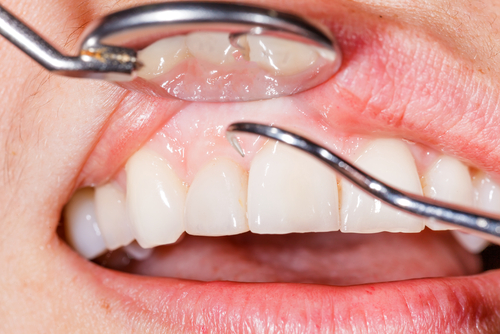 Do You Have Bleeding Gums? Take These Steps